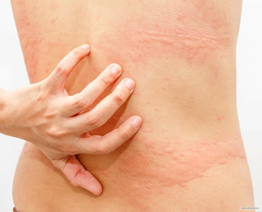 Povidon-Jod-Allergie: Symptome, Diagnose und Behandlung